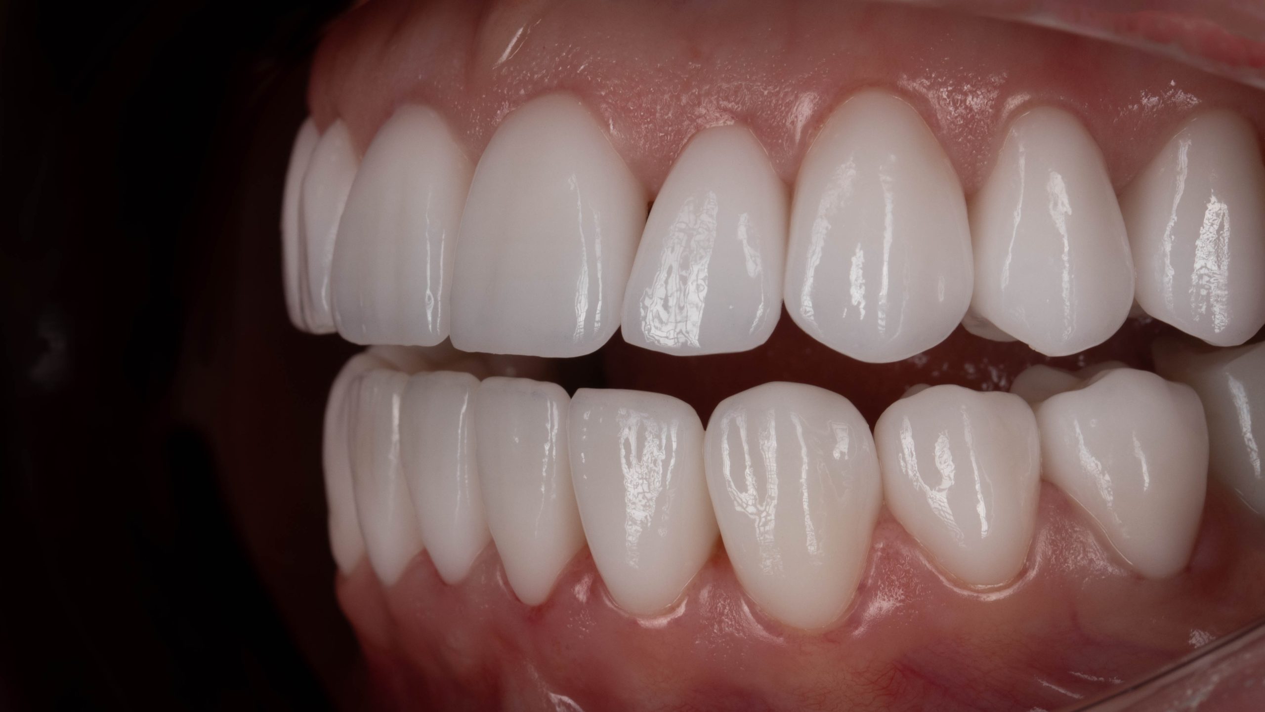 Reabilitare Orală Totală
